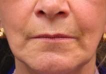Hyaluronic Acid After